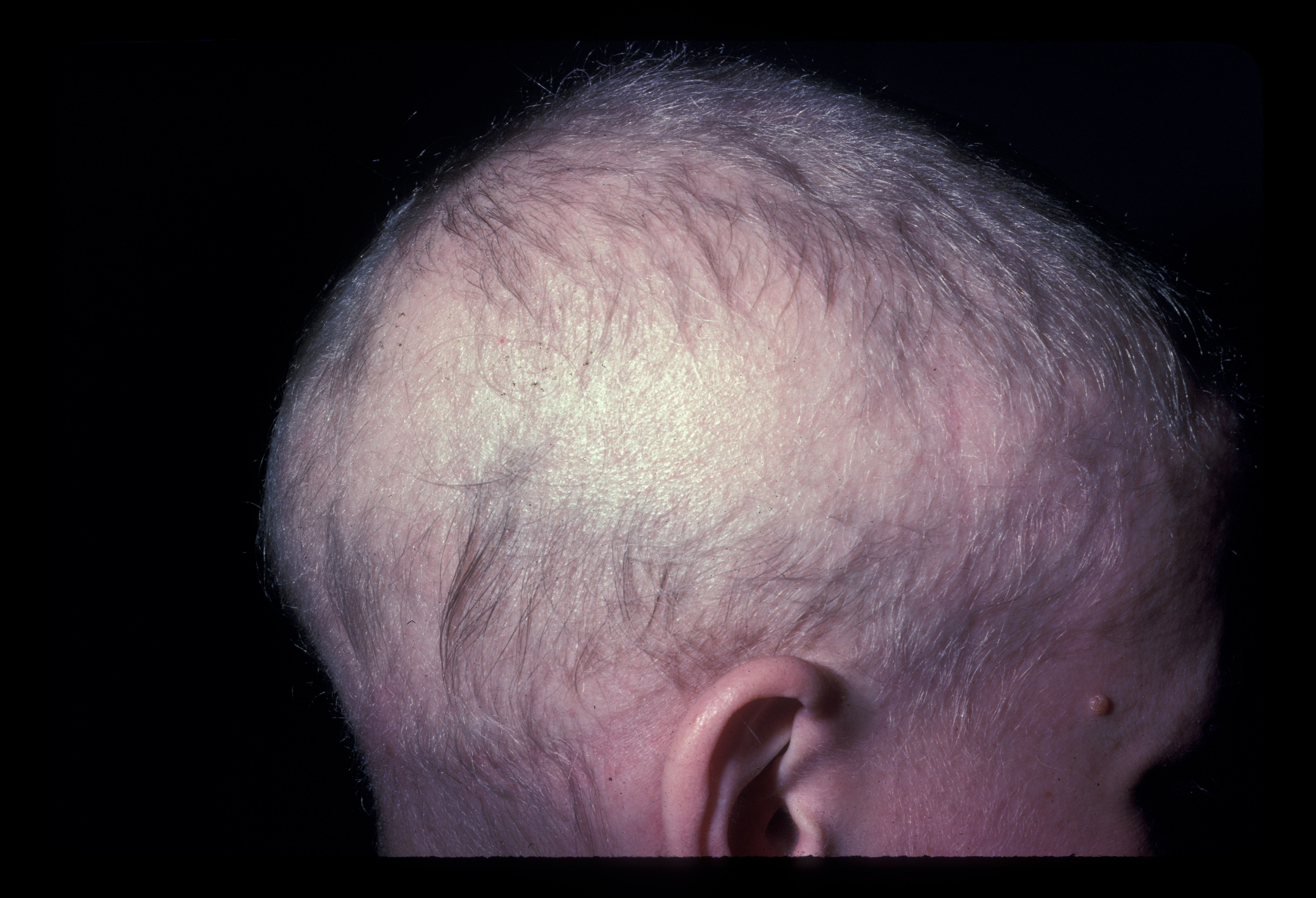 <p>Alopecia Totalis With Regrowth.</p>