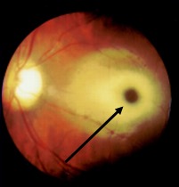 <p>Tay-Sachs Disease. This image of a fundus reveals a cherry-red spot in a 9-month-old boy with Tay-Sachs disease.</p>