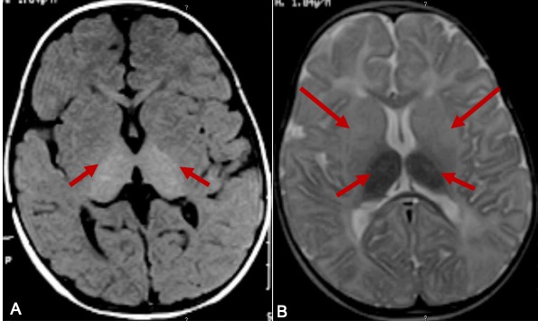 <p>Brain MRI of Tay-Sachs Disease