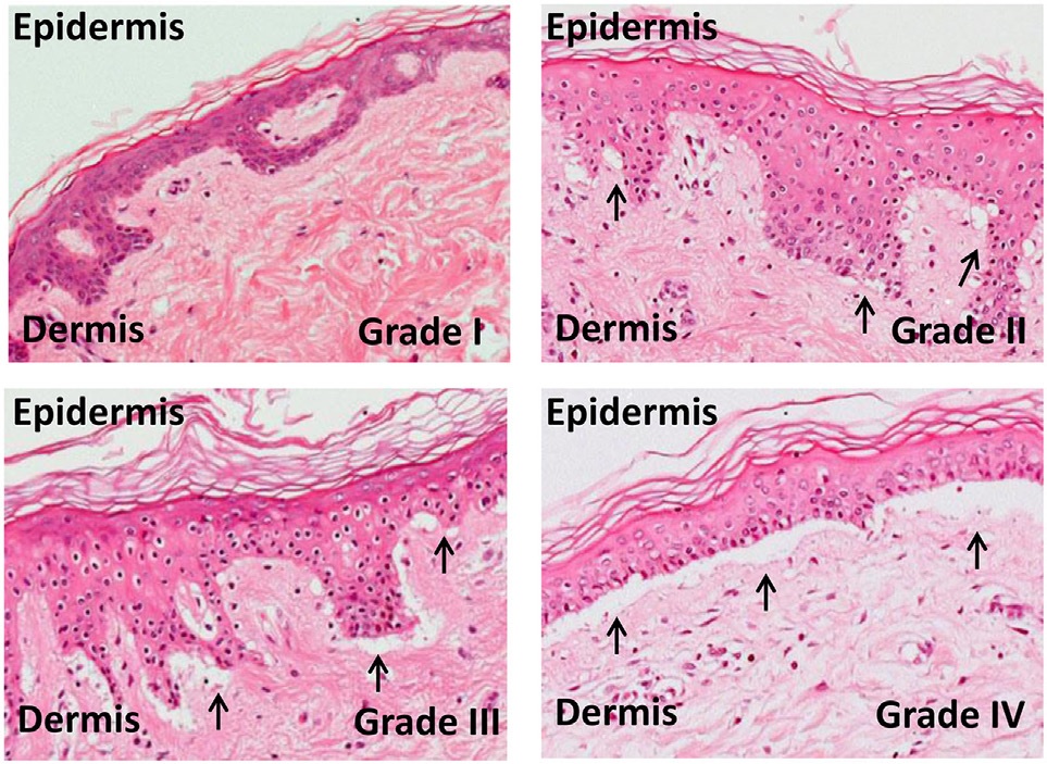 <p>Grades of Skin Graft-Versus-Host Disease</p>