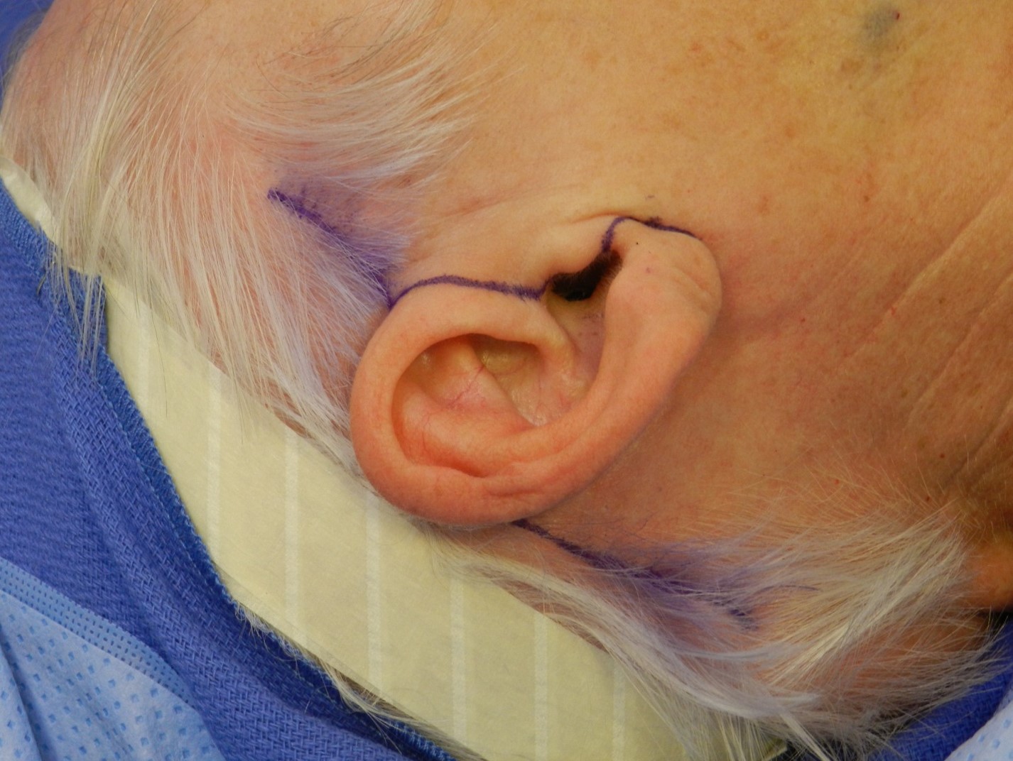<p>Blair Rhytidectomy Incision Marking Demonstrating the Post-Tragal Approach in a Female Patient.</p>