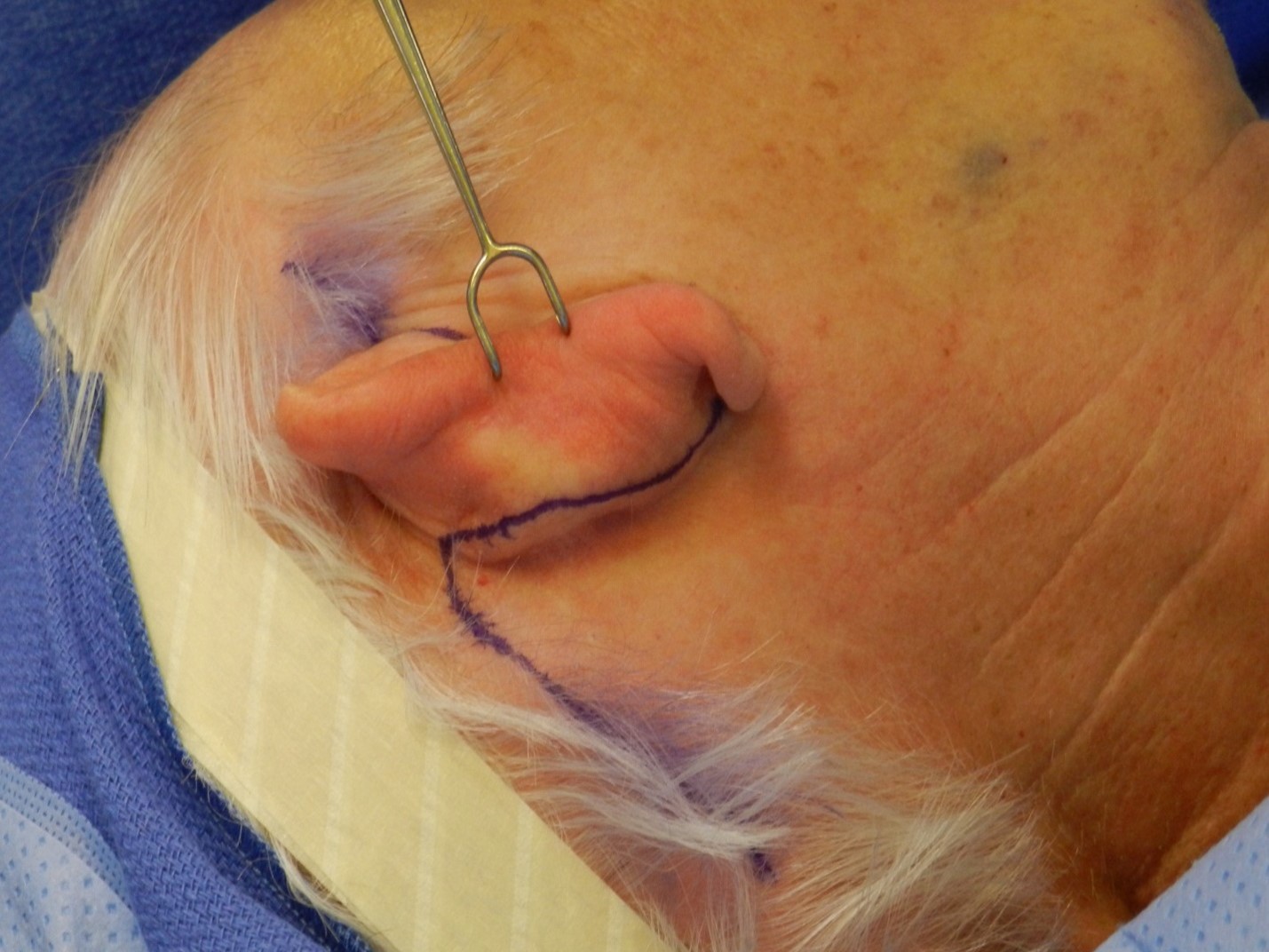 <p>Blair Rhytidectomy Incision Marking Demonstrating the Postauricular Aspect of the Incision.</p>