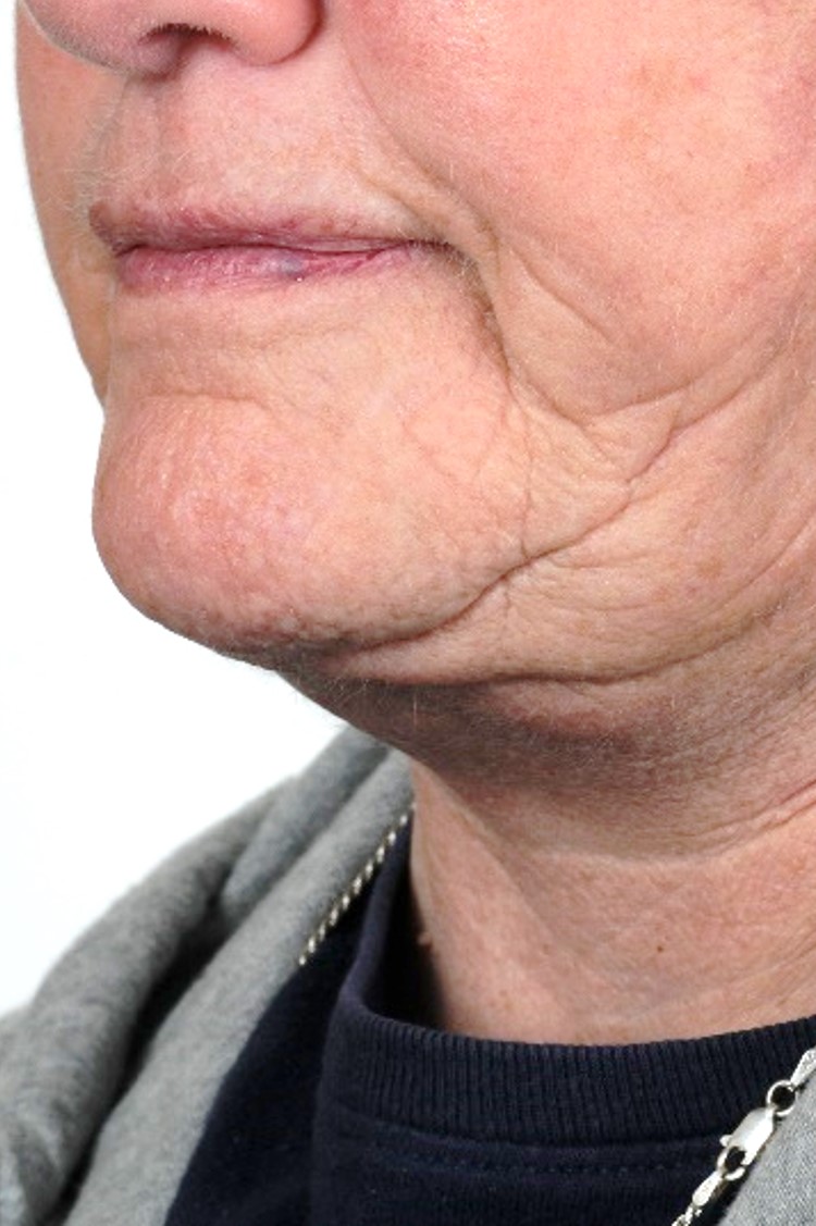 <p>Cobra Neck Deformity