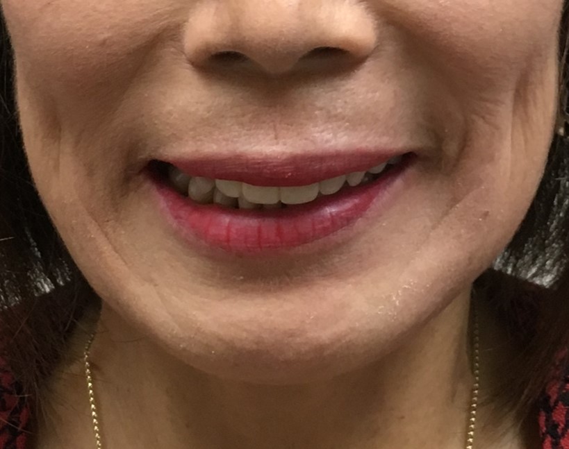 <p>Left Marginal Mandibular Nerve Injury