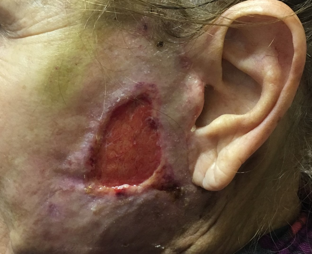 <p>Full-Thickness Necrosis of the Skin Flap.</p>