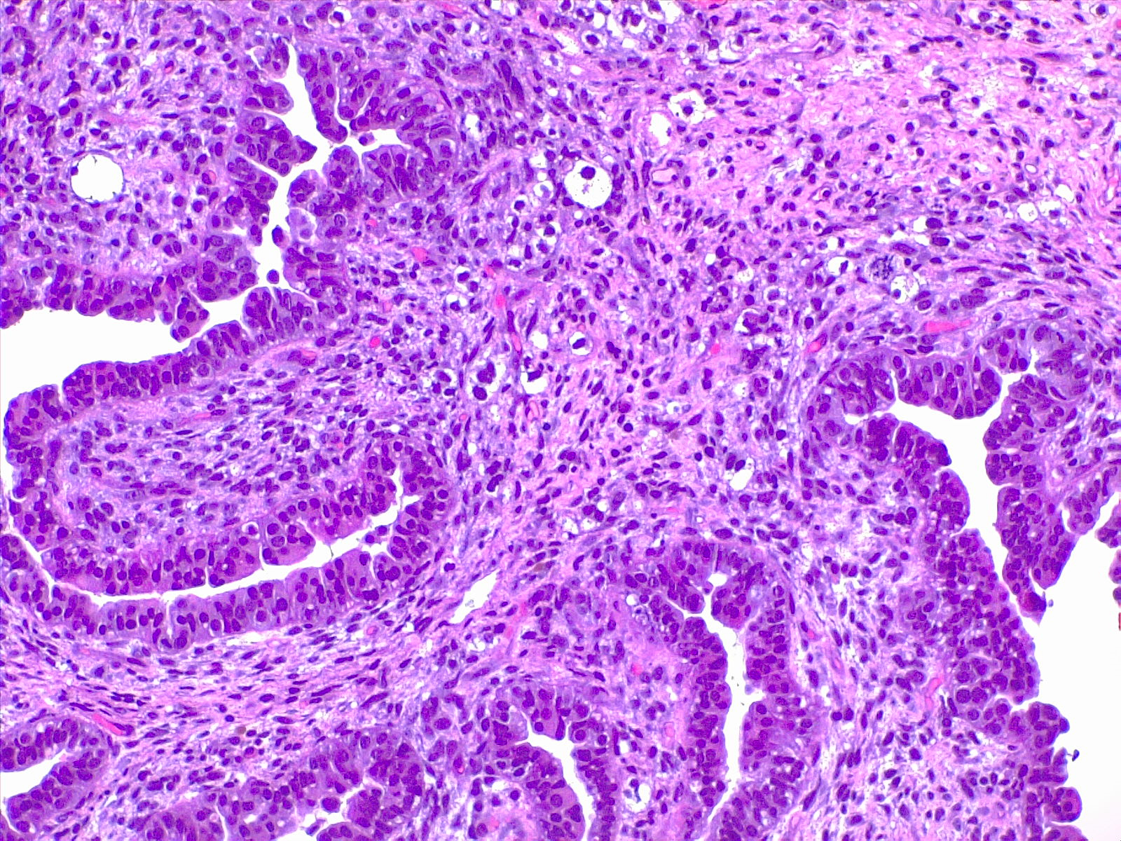 Uterus, adenosarcoma. 4x H/E