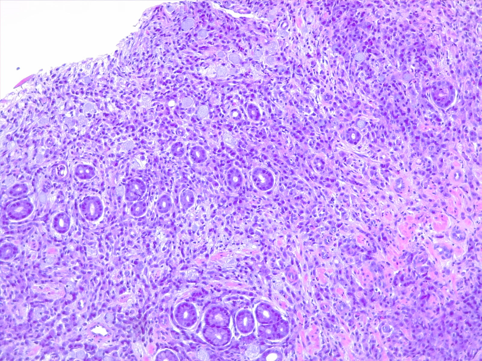 <p>Signet Ring Carcinoma