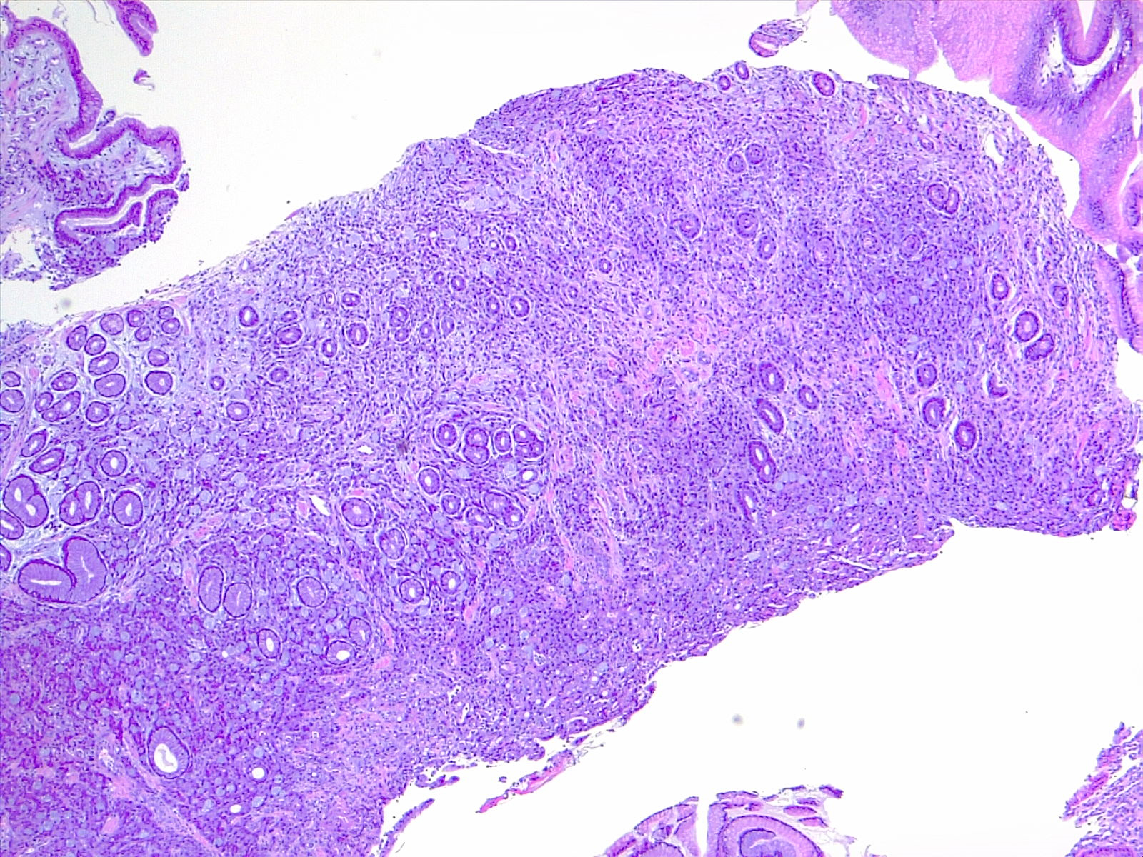 <p>Diffuse Carcinoma of the Stomach