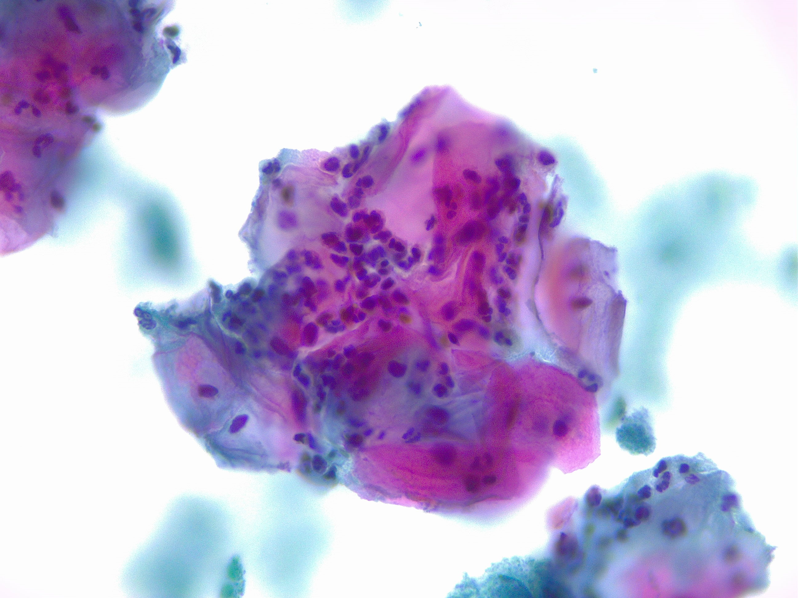 <p>Squamous Cells With Acute Inflammation