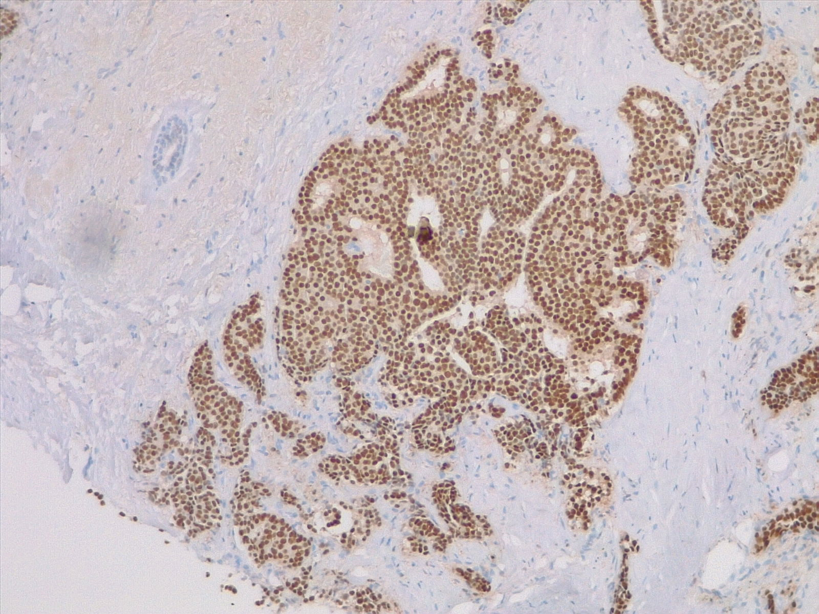 <p>Breast Estrogen Receptor Staining</p>