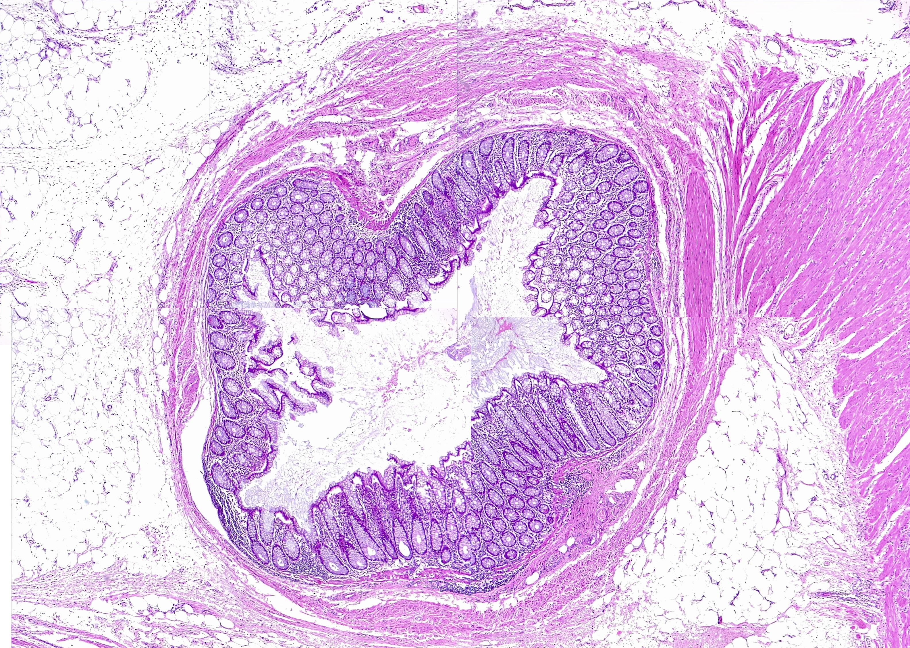 <p>Colon, Diverticulum. Diverticulosis. H/E 1&times;</p>