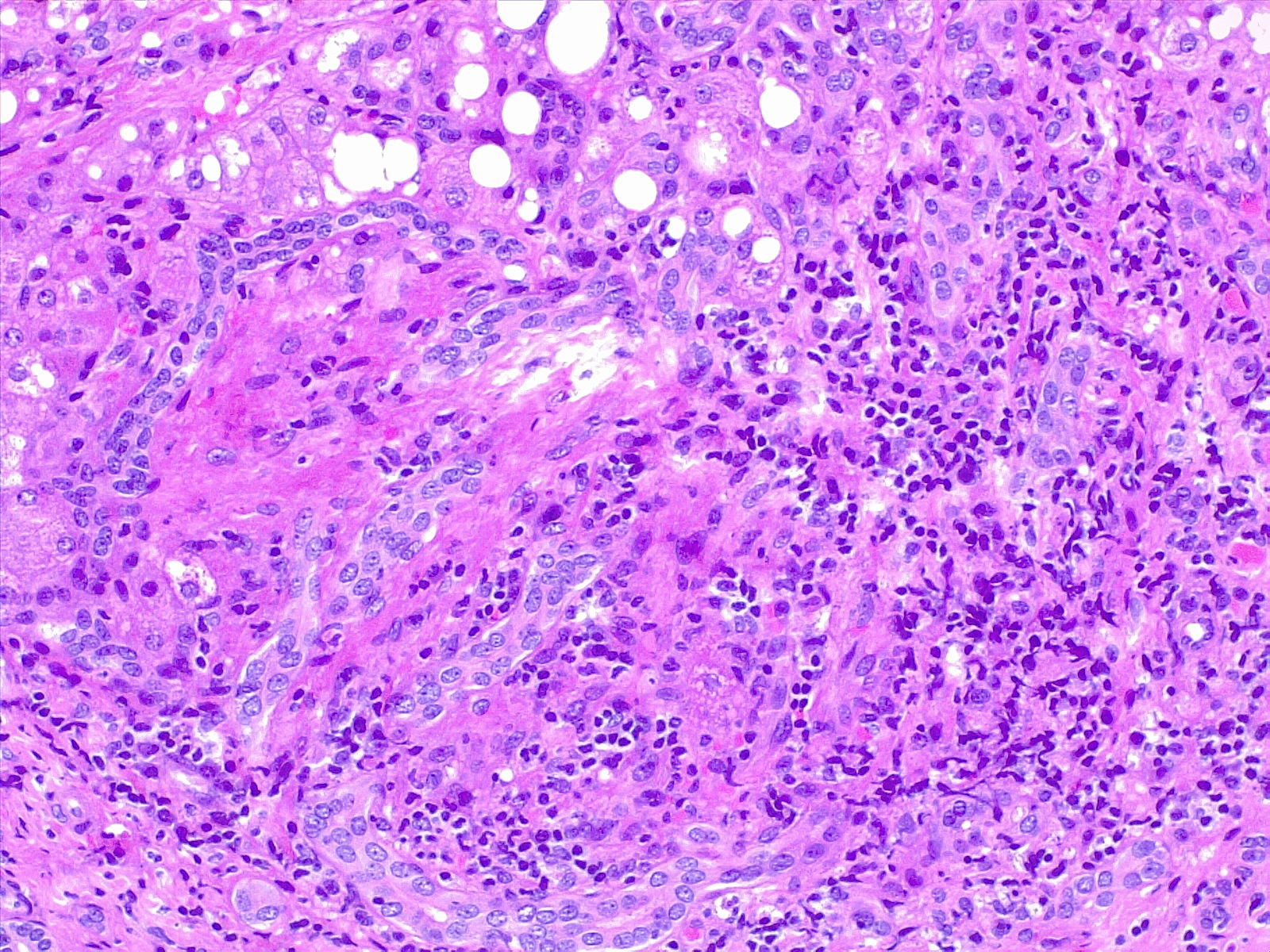 <p>Liver Biopsy Hematoxylin and Eosin Stain