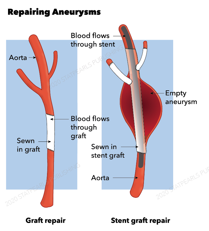 <p>Aneurysm repair, stent, graft, aorta</p>
