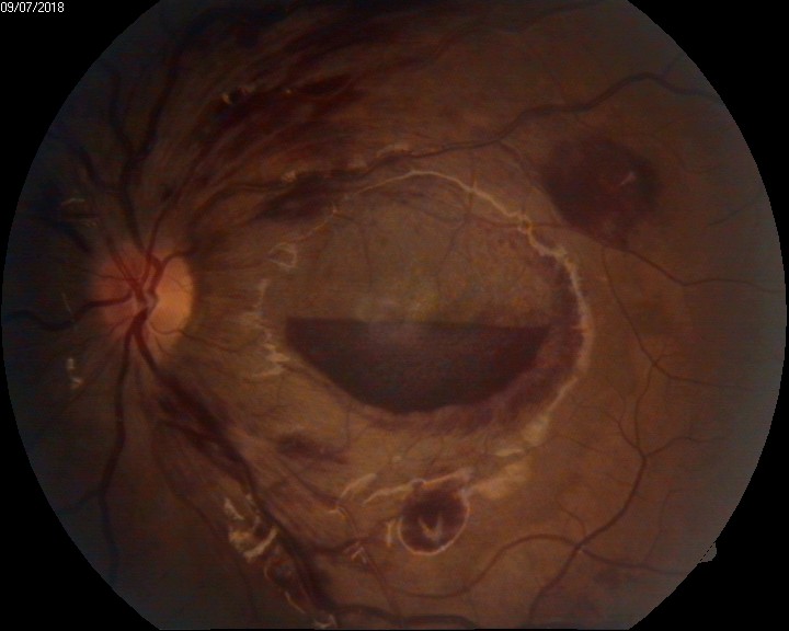 <p>Intraocular Hemorrhage in Anemic Retinopathy