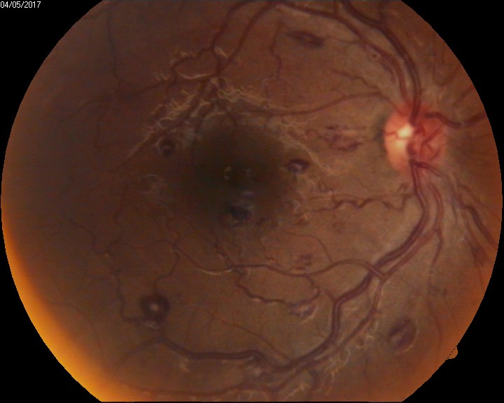 <p>Intraocular Hemorrhage With Roth Spots