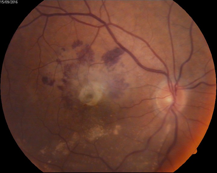 <p>Intraocular Hemorrhage&nbsp;on Funduscopy