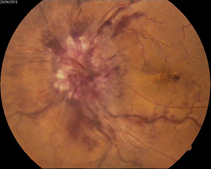 <p>Intraocular Hemorrhage With Disc Hemorrhage in Grade 4 Papilledema