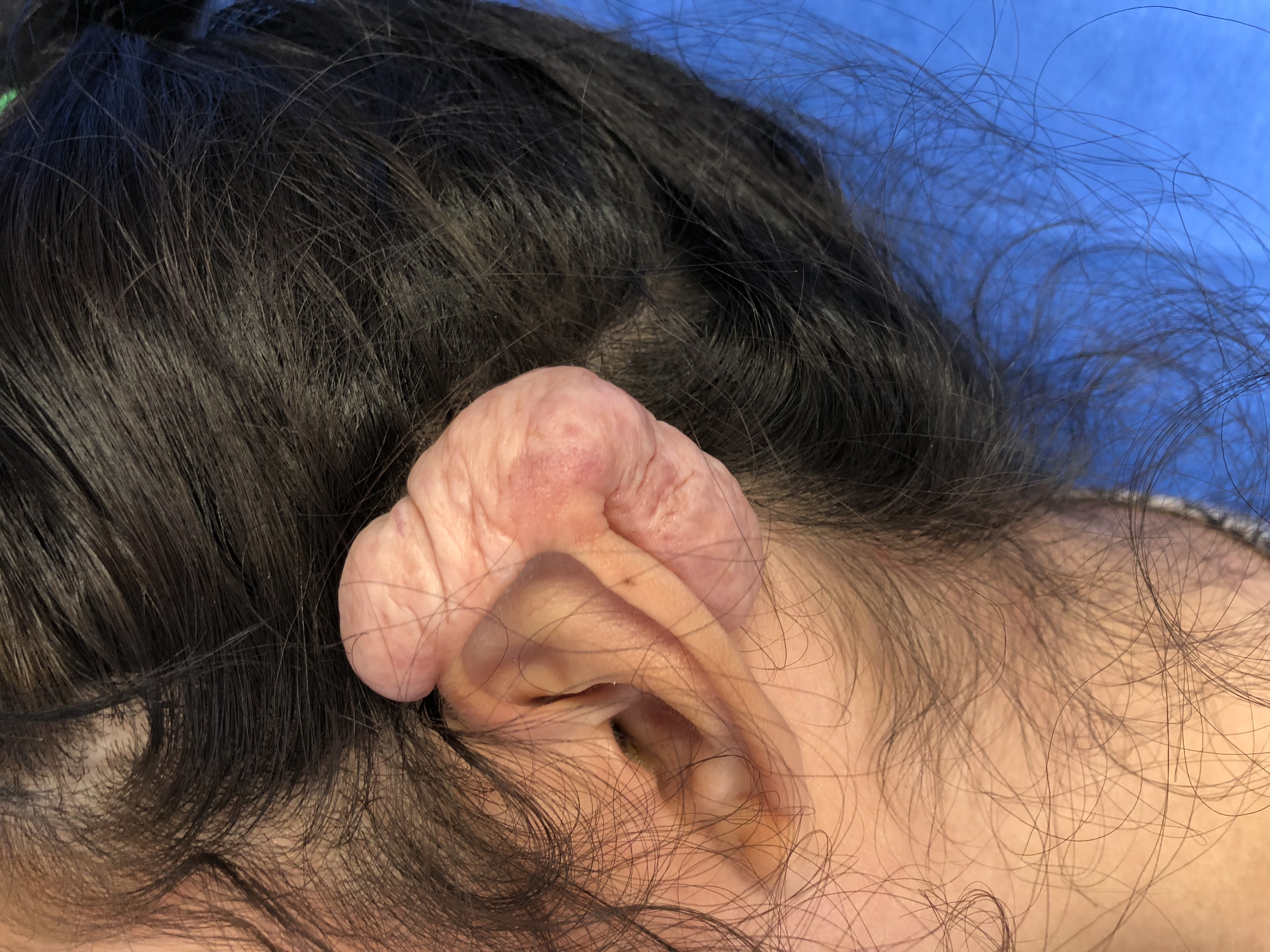 <p>Helical&nbsp;Keloid Scar