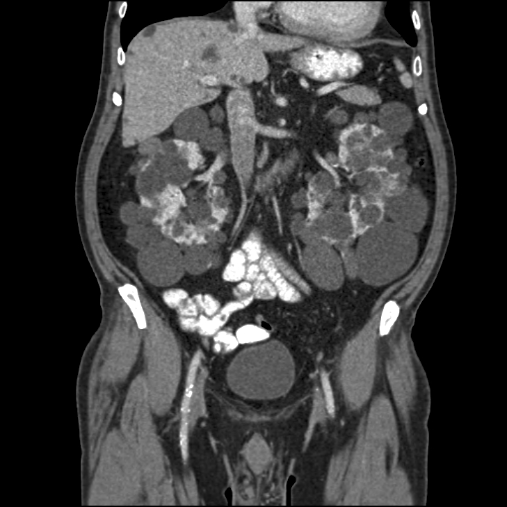 <p>CT scan of the abdomen shows Autosomal Dominant Polycystic disease</p>