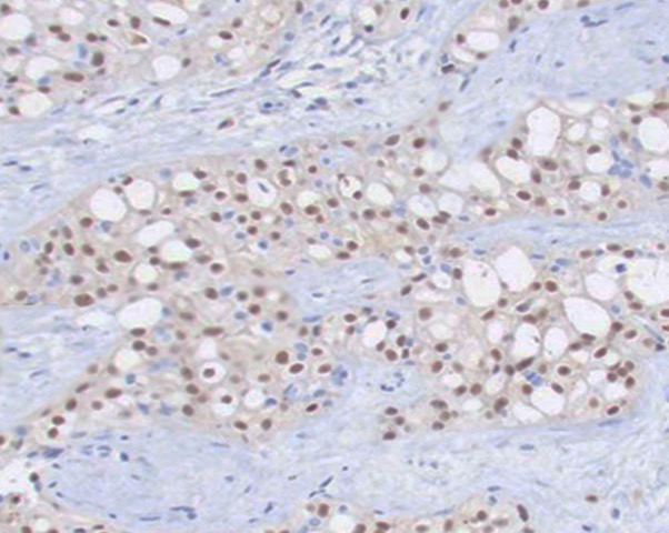 <p>Pleomorphic Lobular Breast Carcinoma</p>
<p>&nbsp;</p>