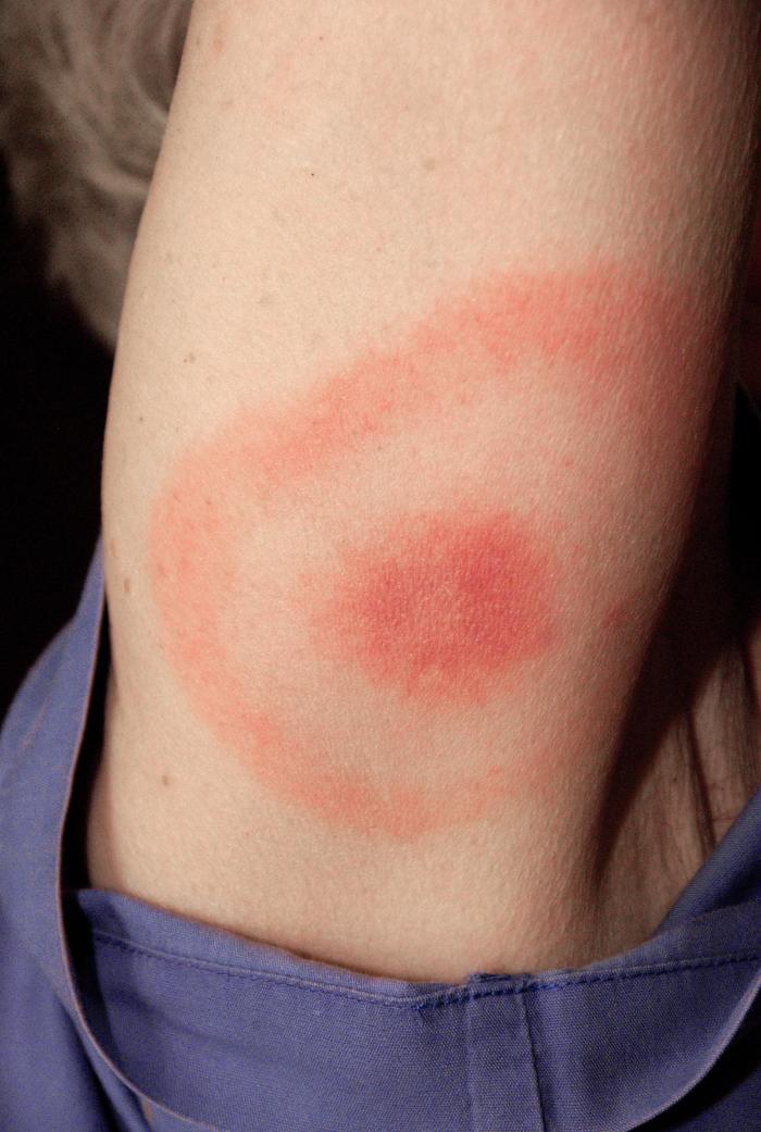 <p>Lyme Disease "Bulls-Eye" Rash. This image illustrates the characteristic rash present in some cases of Lyme disease.</p>