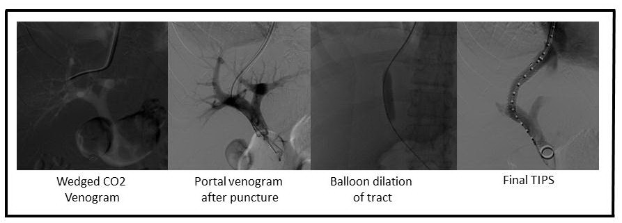 <p>Transjugular Intrahepatic Portosystemic Shunt (TIPS) Procedure.</p>