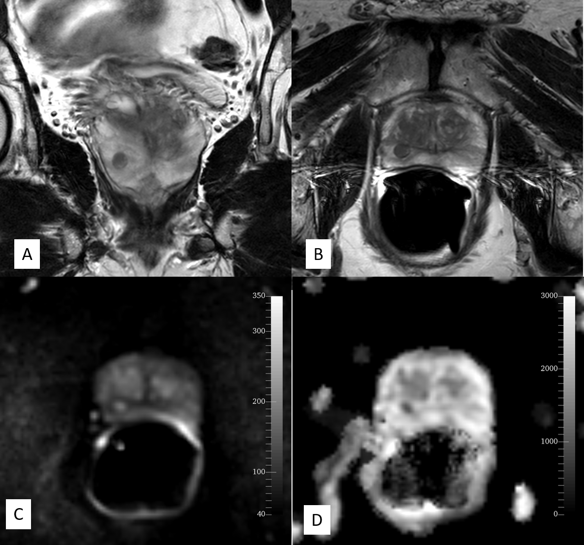 <p>Normal Prostate, Magnetic Resonance Image Using Endorectal Coil