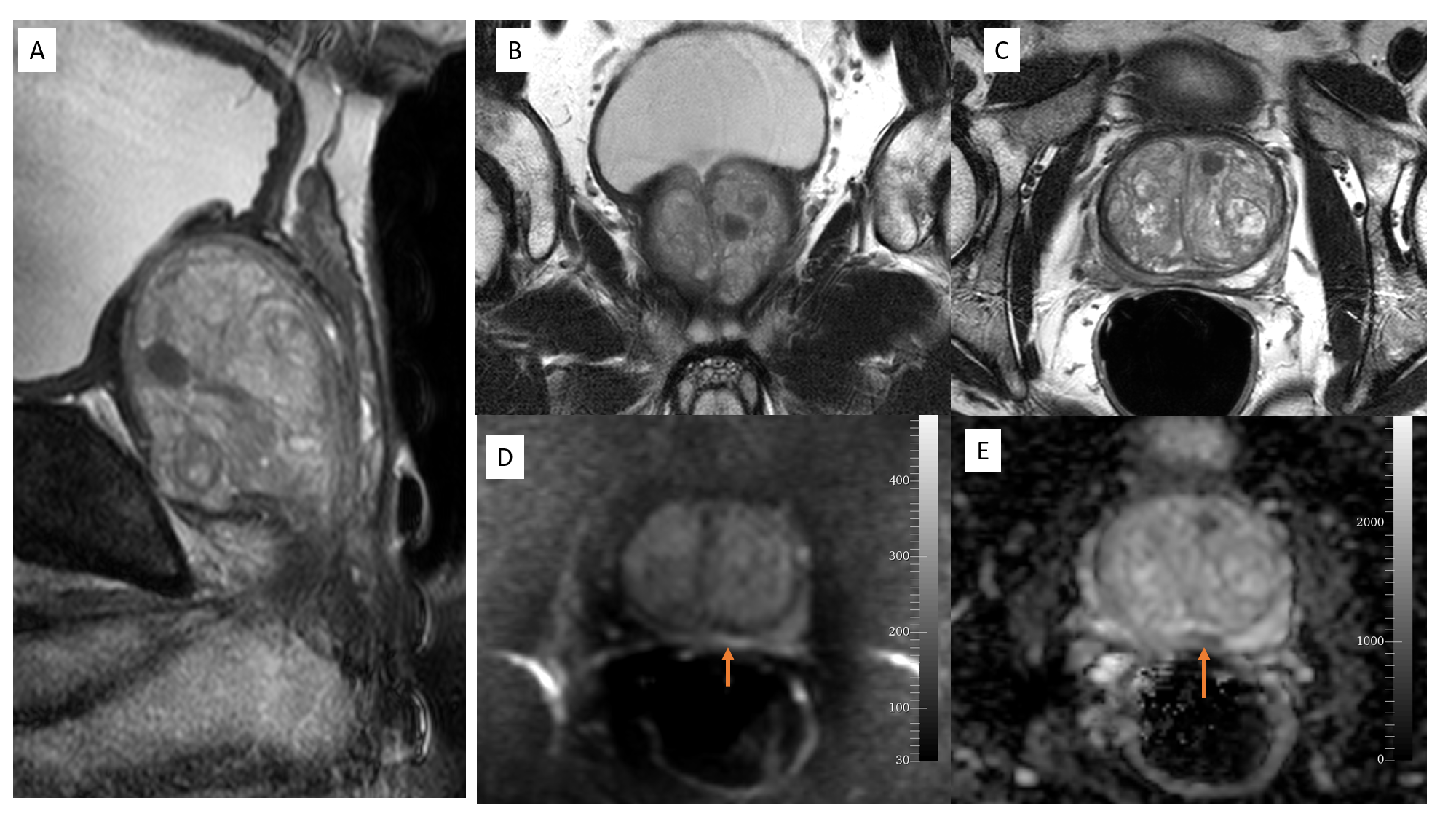 <p>Magnetic Resonance Image of Prostate, Imaging Reporting and Data System-2 Classification