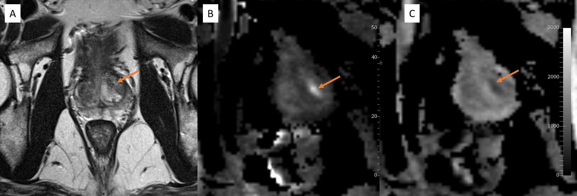 <p>Magnetic Resonance Image of Prostate, Imaging Reporting and Data System 3 Classification