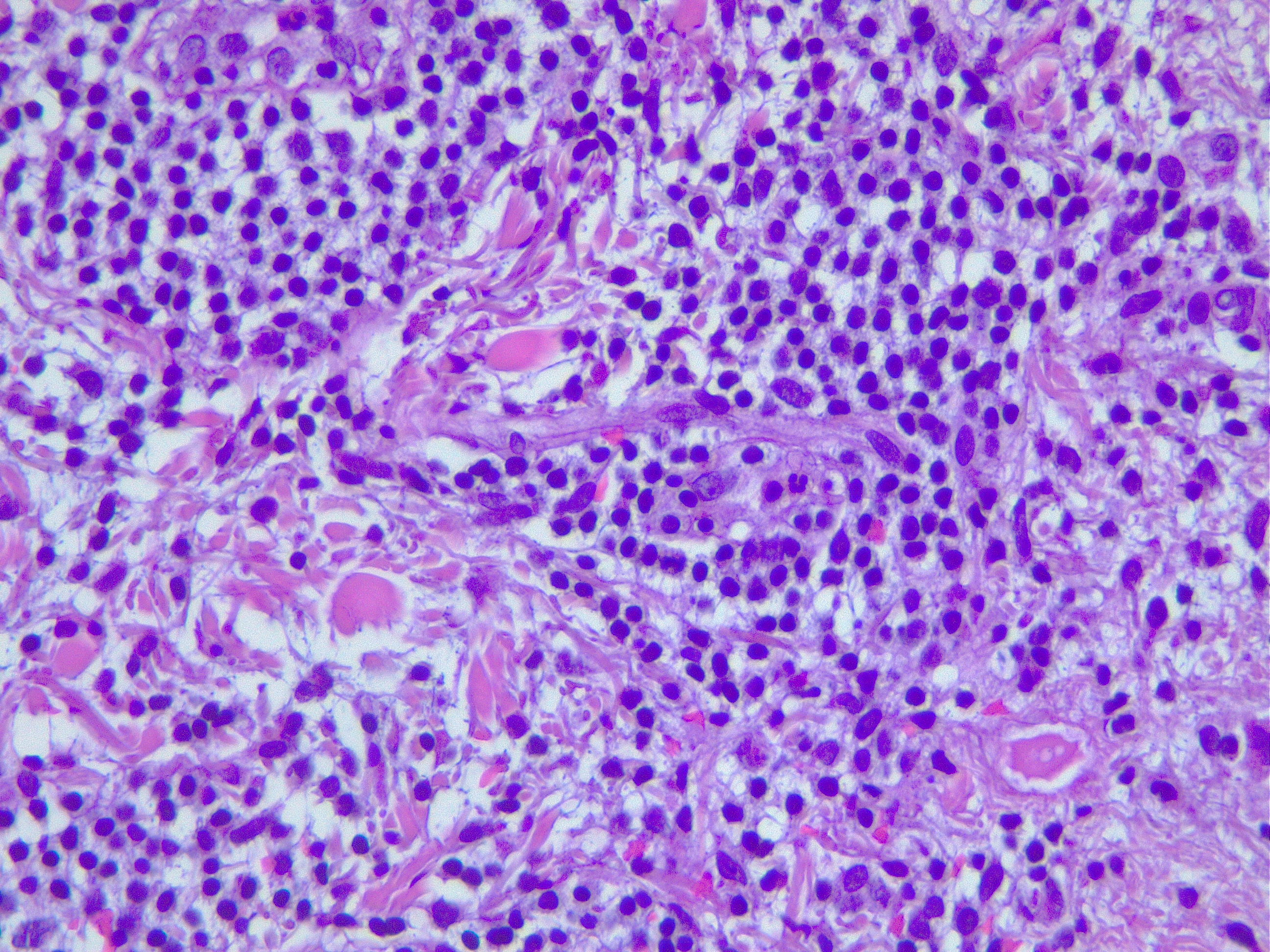 Inflammatory infiltrate in Jessner's dermatitis, mostly of small mature lymphocytes.