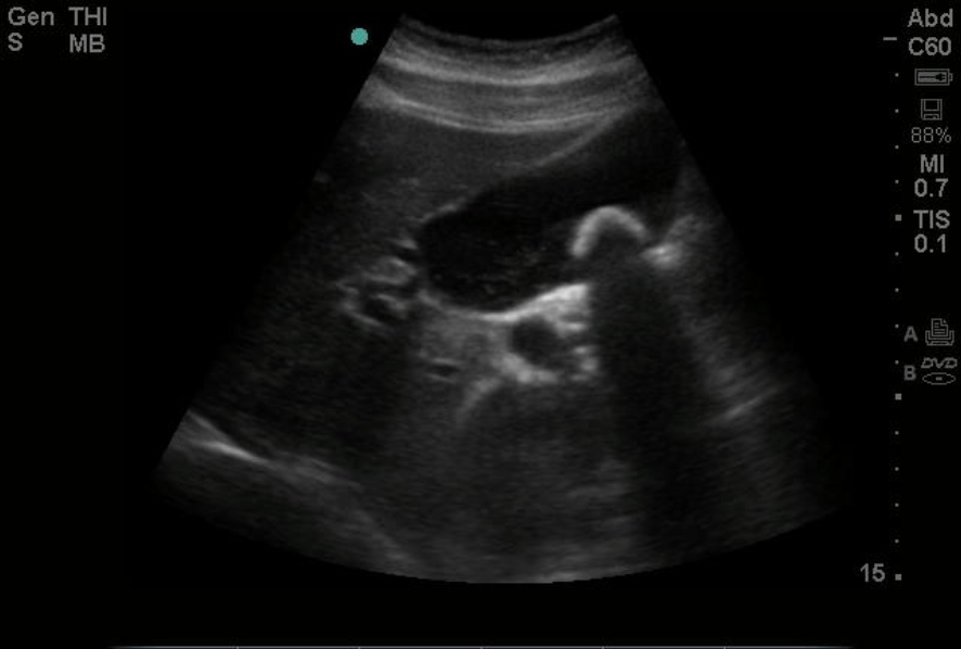 <p>Gallstone, Ultrasound Image. This image shows a gallstone on point-of-care ultrasound.</p>