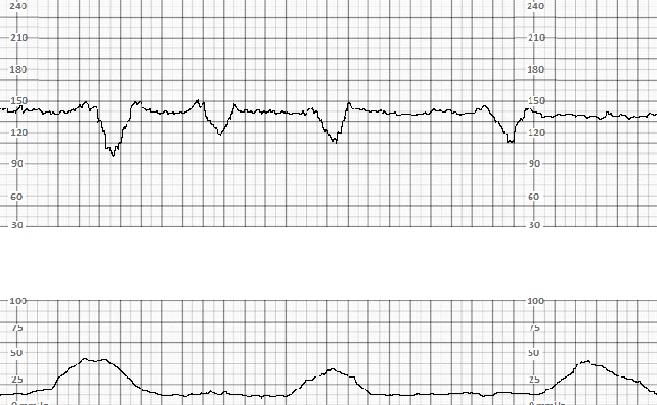 <p>Variable Decelerations</p>