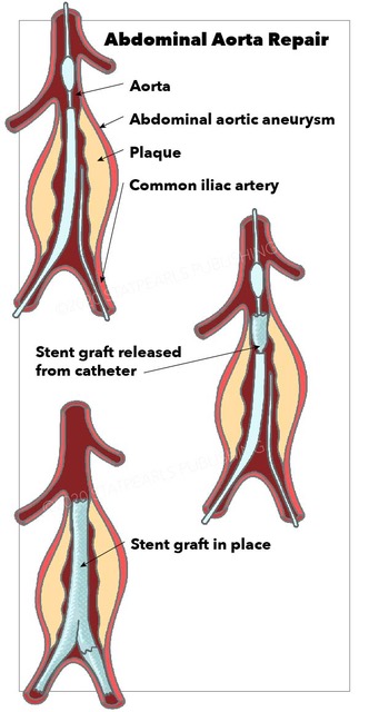 Abdominal Aorta Repair, aneurysm, common iliac artery, stent graft released from catheter