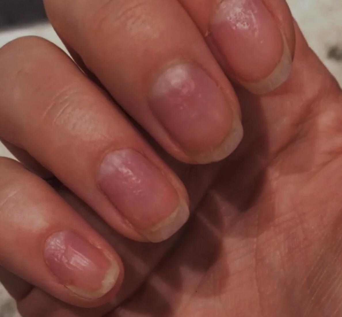 <p>Nails in Psoriasis