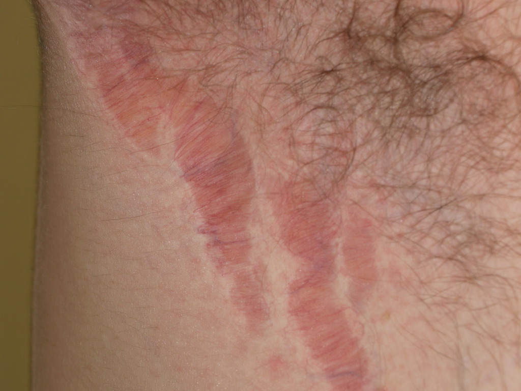 <p>Striae Atrophicans Due to Potent Topical Corticosteroid Application to Axilla.</p>