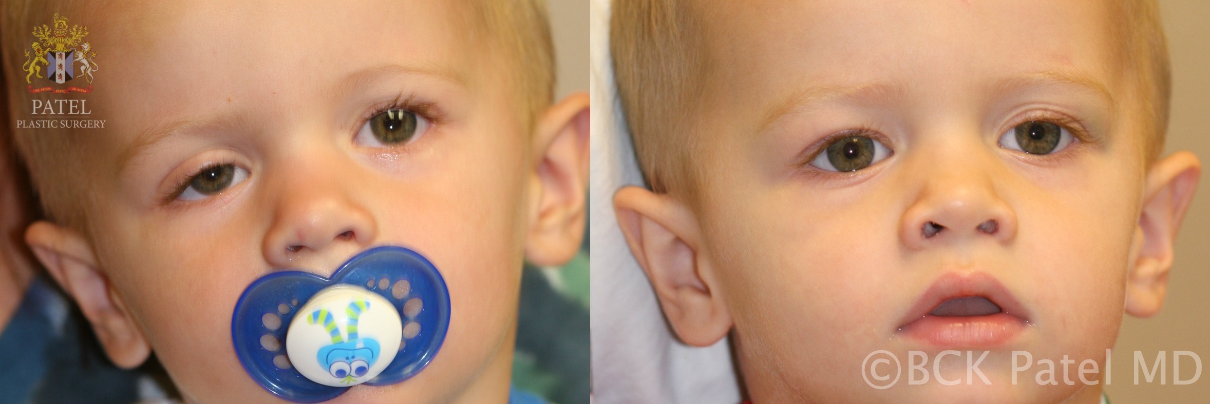 <p>Congenital Ptosis