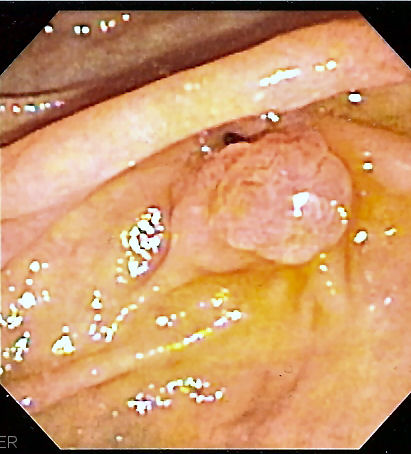 <p>Endoscopic image of the ampulla of vater</p>