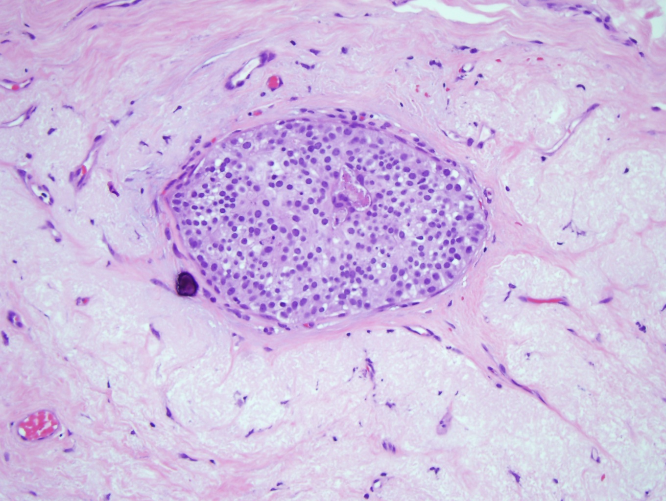 <p>Ductal Carcinoma in Situ, Low Grade