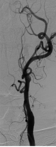 <p>Occlusion of the Internal Carotid Artery