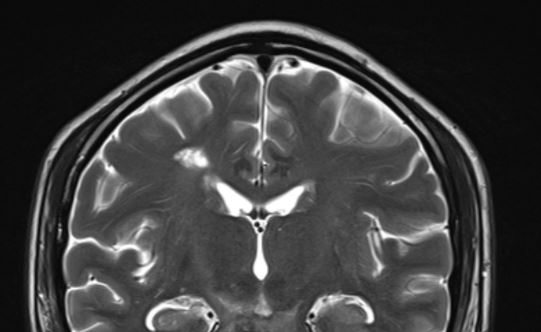 <p>Popcorn-Like Appearance of a Cavernoma