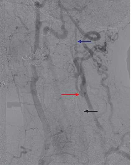 <p>Collateralization in Common Carotid Artery (CCA) Occlusion