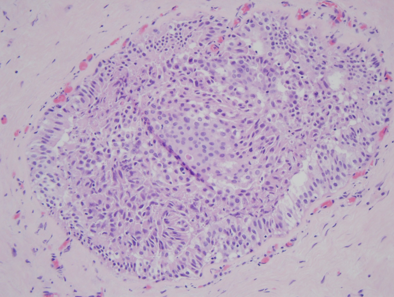 Atypical ductal hyperplasia (ADH) (x20)