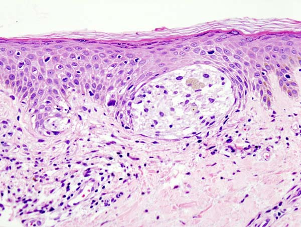<p>Lentigo Maligna Melanoma