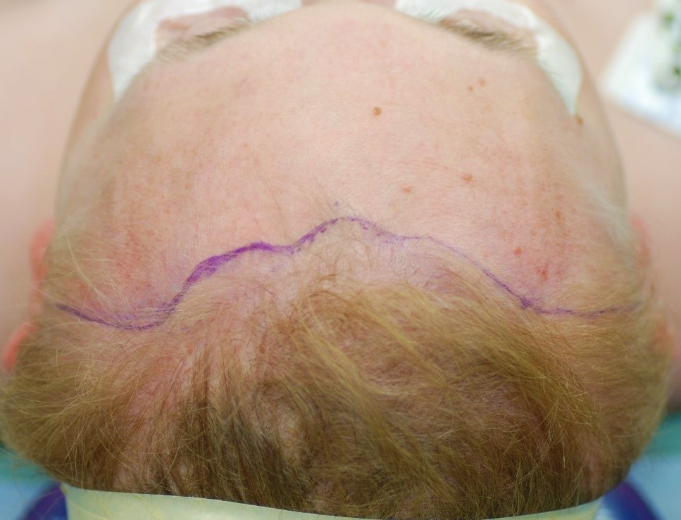 <p>Preoperative Marking of the Pretrichial Brow Lift Incision