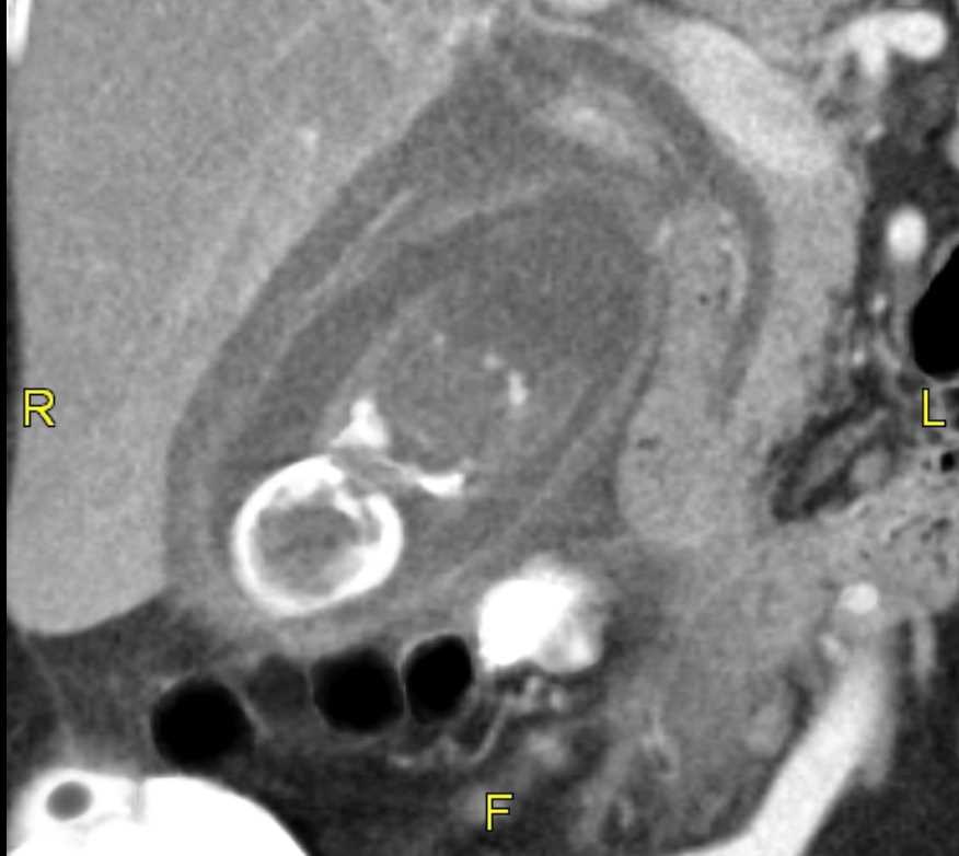 <p>Cholecystitis Wall Thickening With Pericholecystic Fluid Gallstone, Computed Tomography