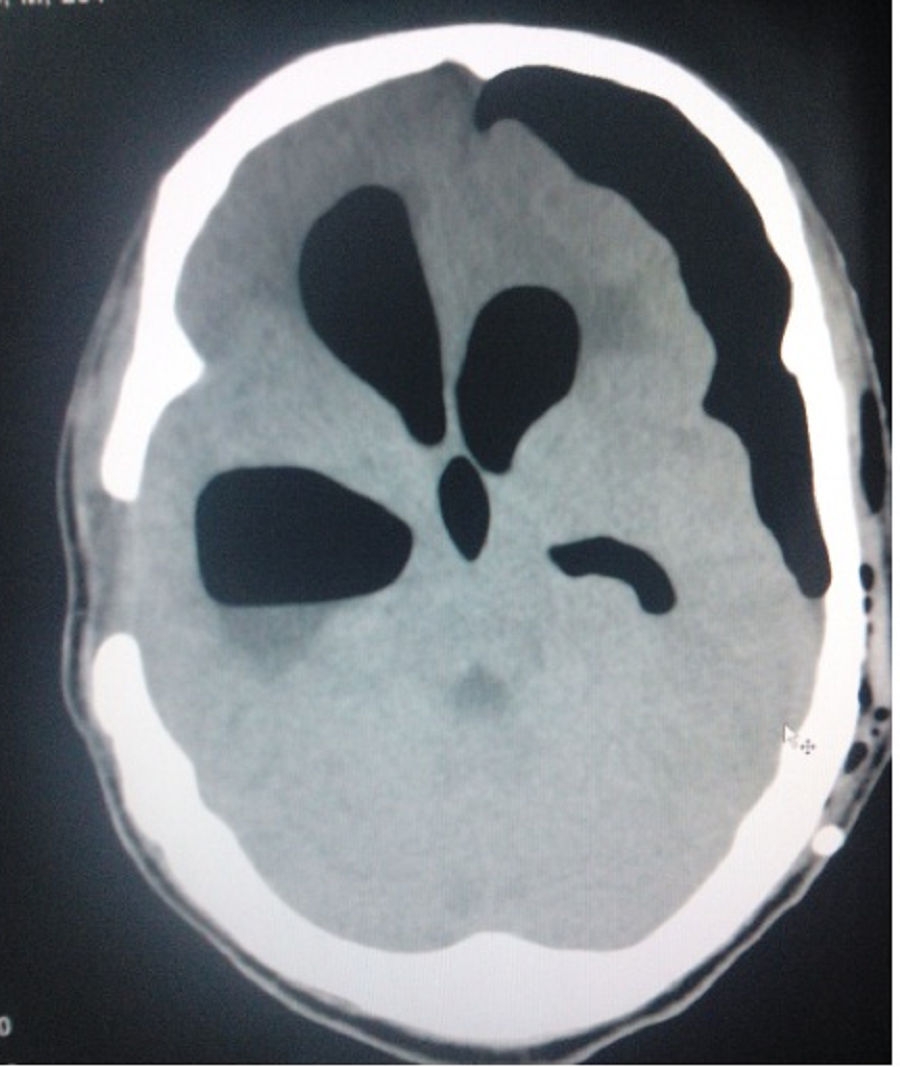 <p>Pneumocephalus and Pneumoventriculi