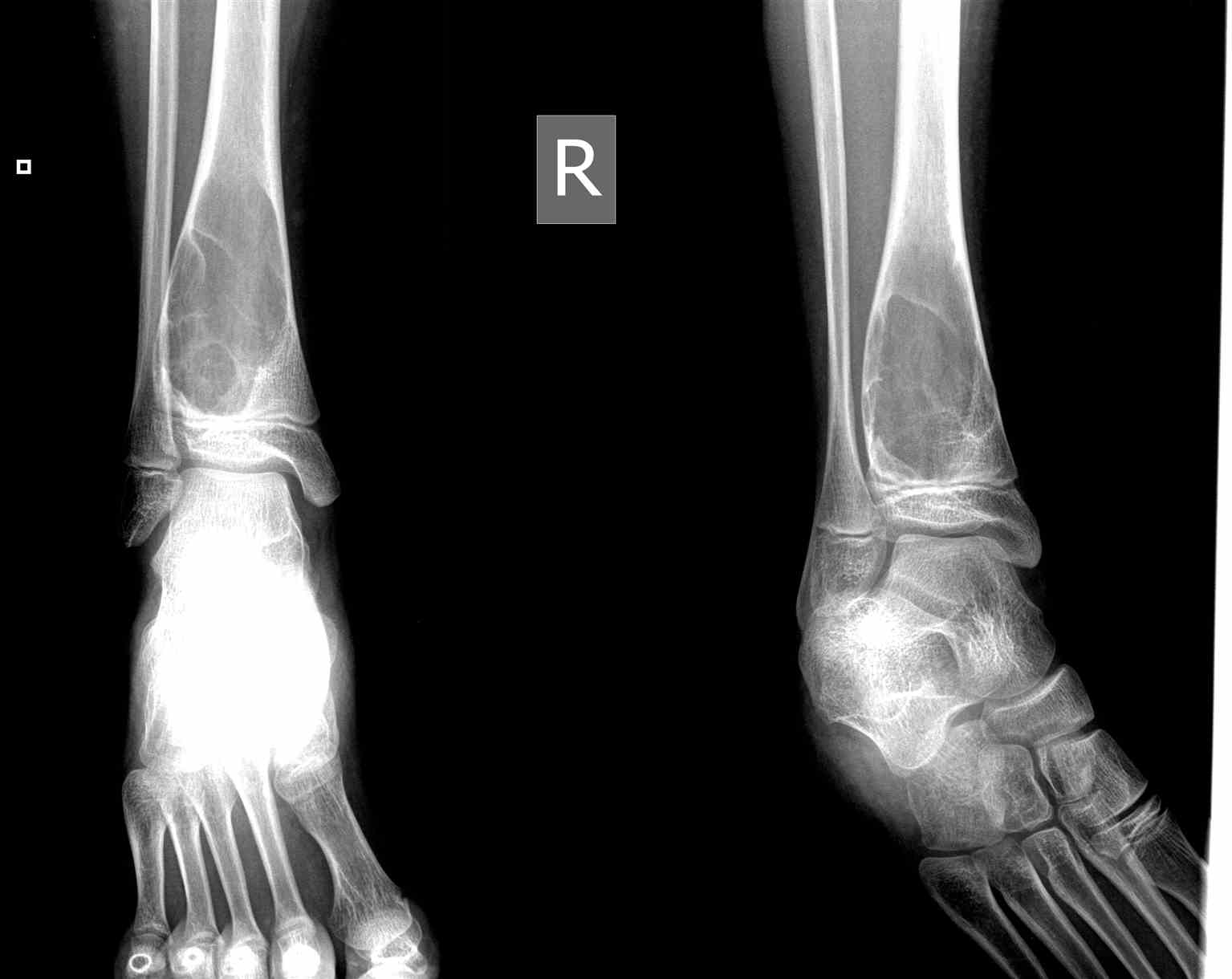 <p>Ankle Radiograph,&nbsp;Aneurysmal Bone Cyst