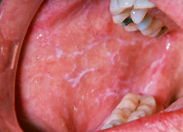 <p>Lichen Planus Present With Wickham's Striae on Buccal Mucosa</p>