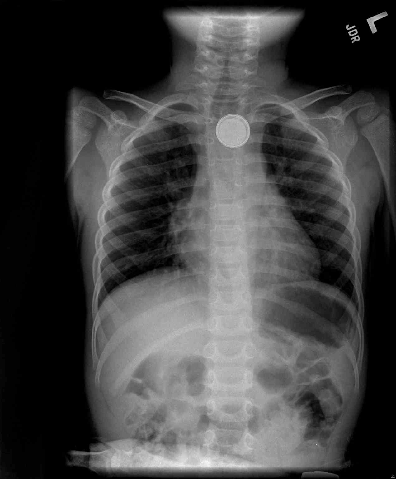 <p>Button Battery in the Upper Esophagus of a Child