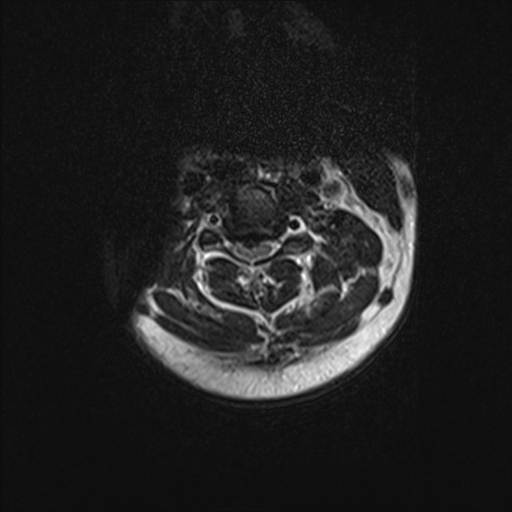 <p>Cervical Spine, Magnetic Resonance Image. This image shows an axial view of a herniated disc in the cervical region.</p>